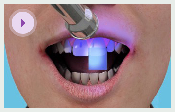 is teeth lasering safe