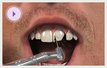 Dental Crowns