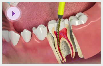 Root Treatment (Multi)