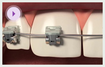 Self Legating Brackets