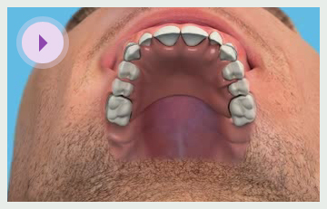 Multiple Teeth