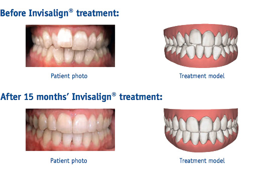 Invisalign Before After